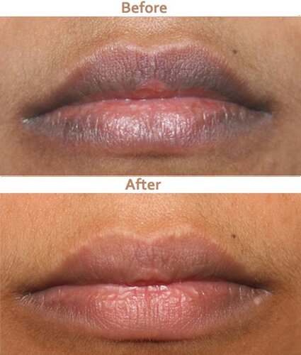 Dark lip before After