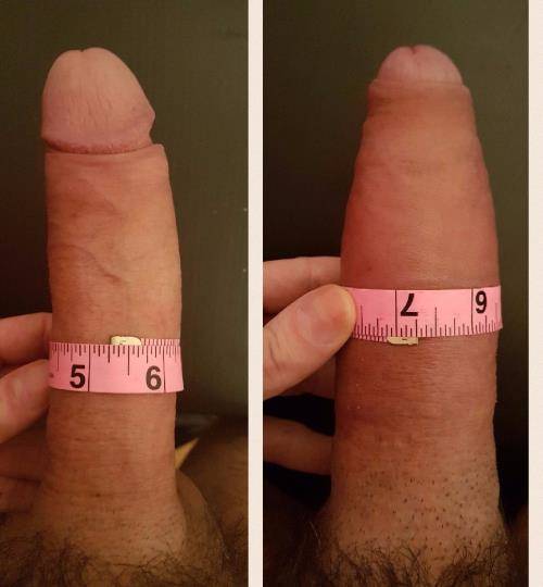 Androfill Patient A Before and After 1
