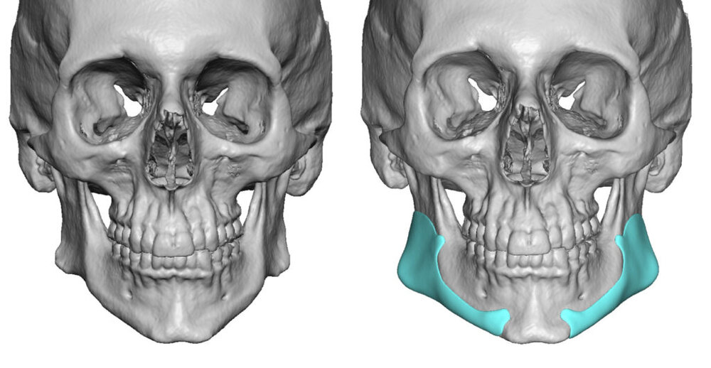 Custom Jaw Angle Implants design front view Dr Barry Eppley Indianapolis 1024x530