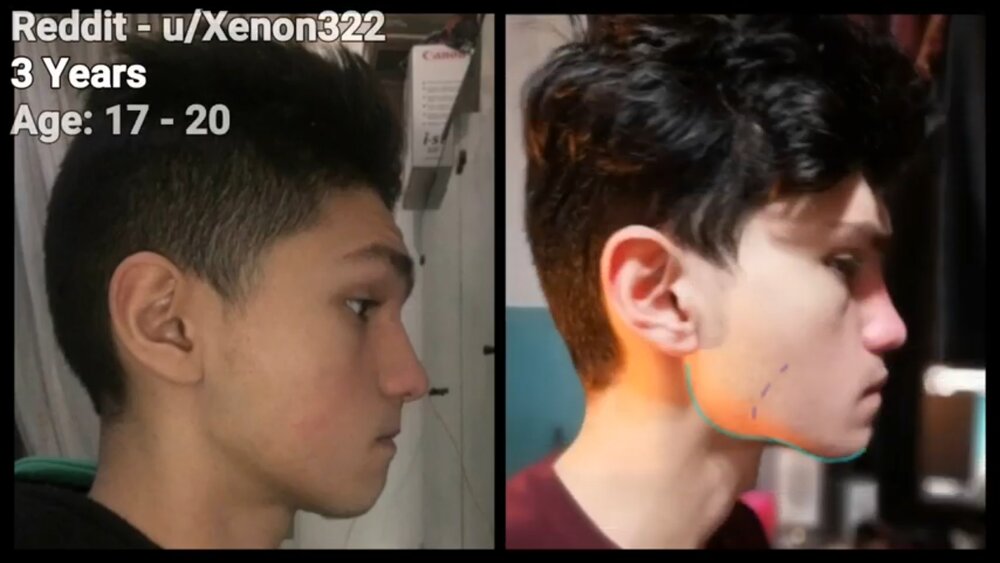 Chewing transformation gonial angle