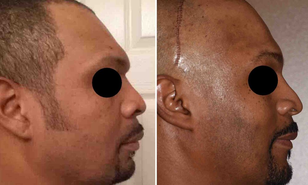 Brow Bone Reduction and Forehead Augmentation result Dr Barry Eppley Indianapolis Brow Bone Reduction and Forehead Augmentation result Dr Barry Eppley Indianapolis
