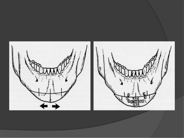 Genioplasty in brief 29 638