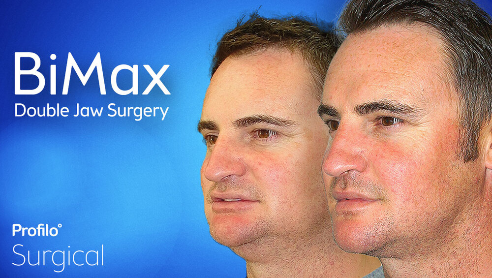 Bimax double jaw surgery profilo surgical sydney newcastle 4