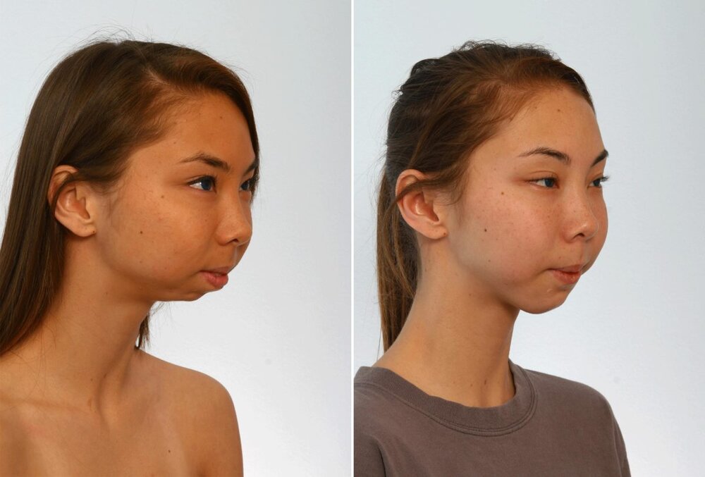 Patient 27995 chin augmentation before after 1200x812