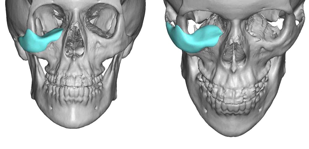 Right Vertical Orbital Dystopia implant design Dr Barry Eppley Indianapolis 