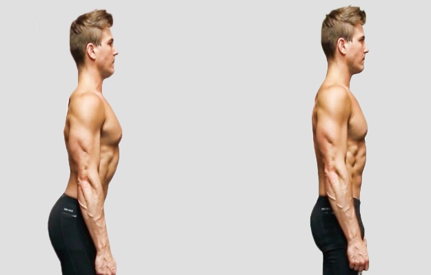 Lordosis posture defect