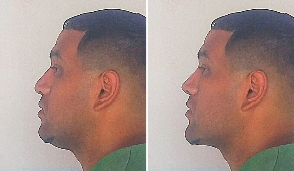 MR face pred side view