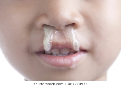 Mucus flowing nose young boy 260nw 467210933