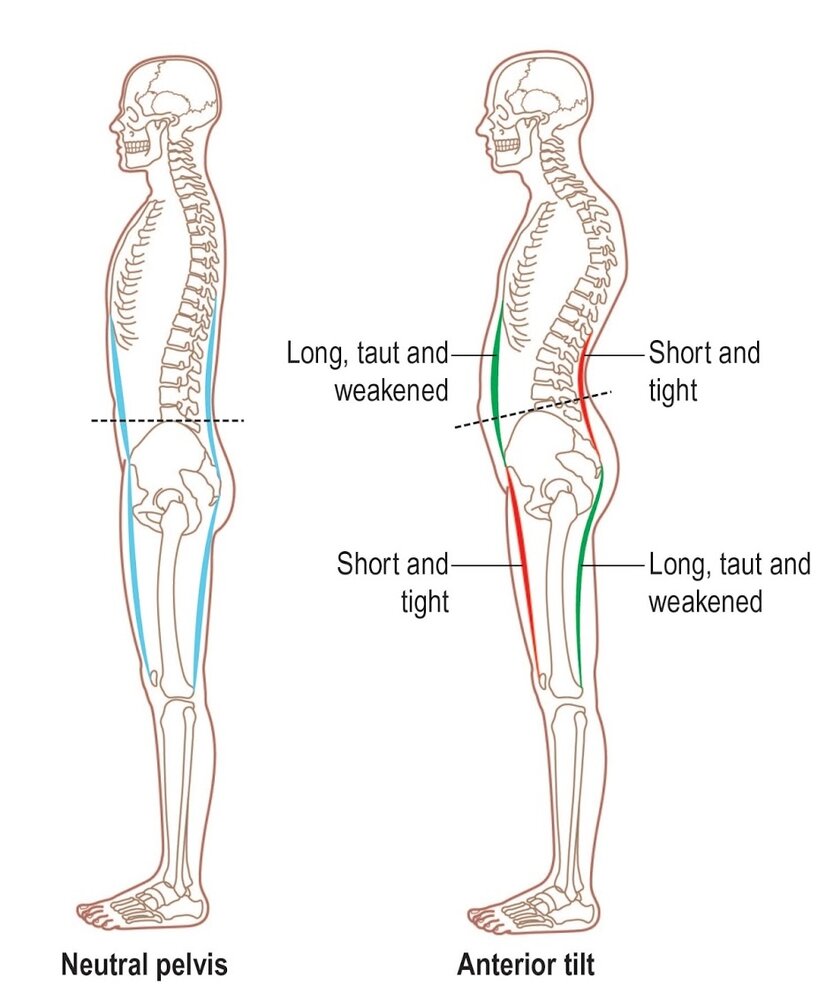 Anterior Pelvic Tilt