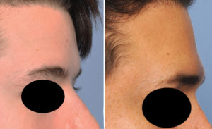 Male custom brow bone implat augmentatin result Dr barry eppley indianapolis 300x183