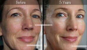 5-Year Retin-A Results ~ Before & After for Wrinkles & Anti-Aging ...