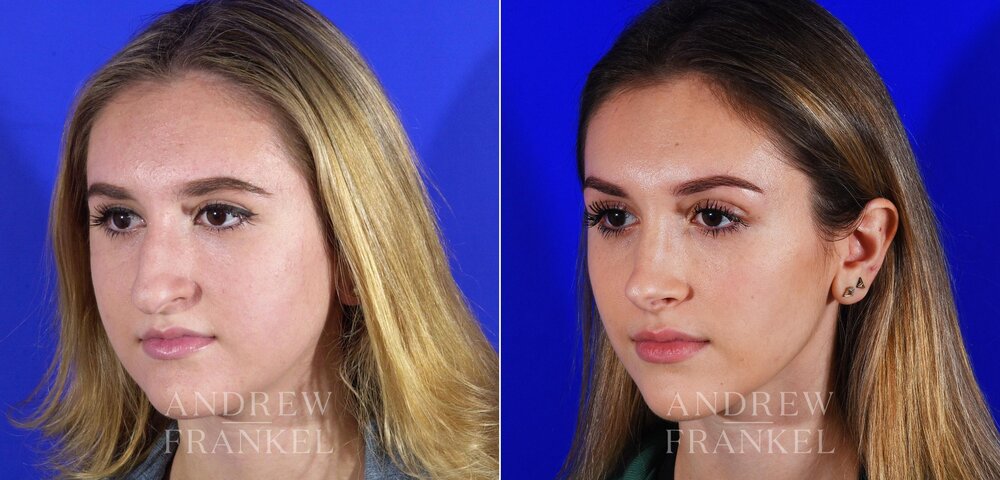Patient 16943 primary rhinoplasty before after 3 Patient 16943 primary rhinoplasty before after 3