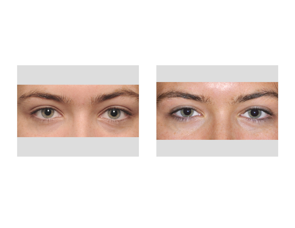Lateral Canthopexy results Dr Barry Eppley Indianapolis
