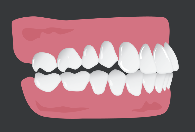 Posterior open bite v2