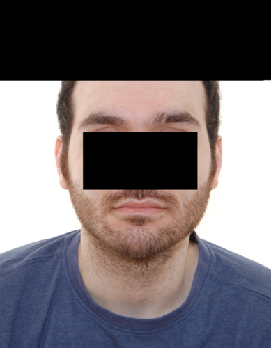 augenbrauentransplantation6.png