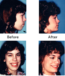5e7cd18a0363e283f84254e3 excess vertical jaw growth