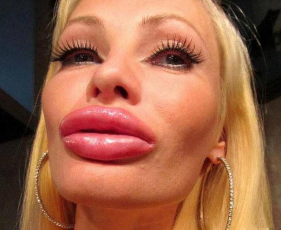 Weird huge fake lips fillers pic1