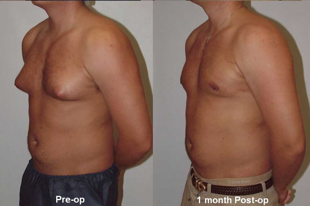 Gynecomastia