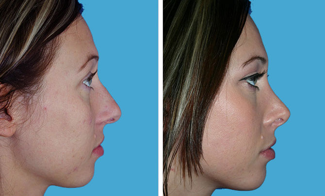 Rhinoplasty septoplasty
