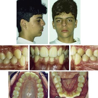 Pretreatment photographs Note Class I molar relationship lower midline deviation Q320