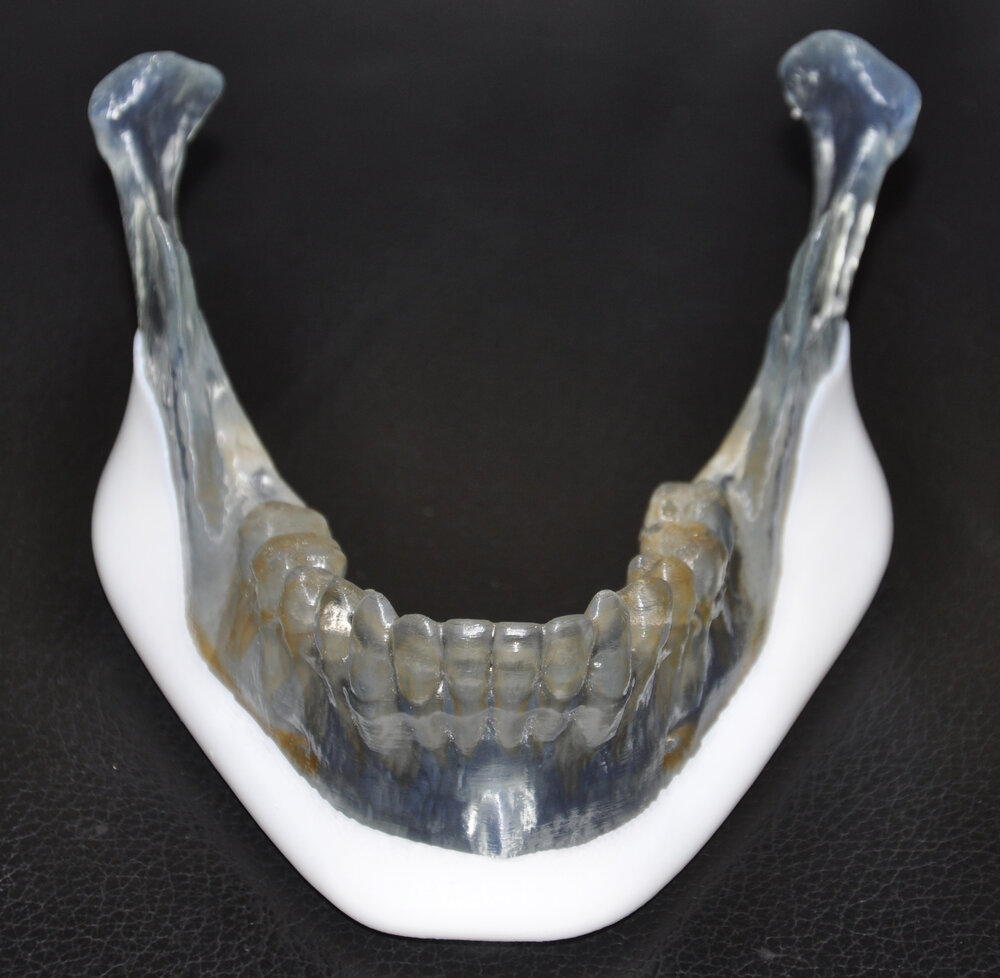 Jawlne implant front view dr barry eppley indianapolis
