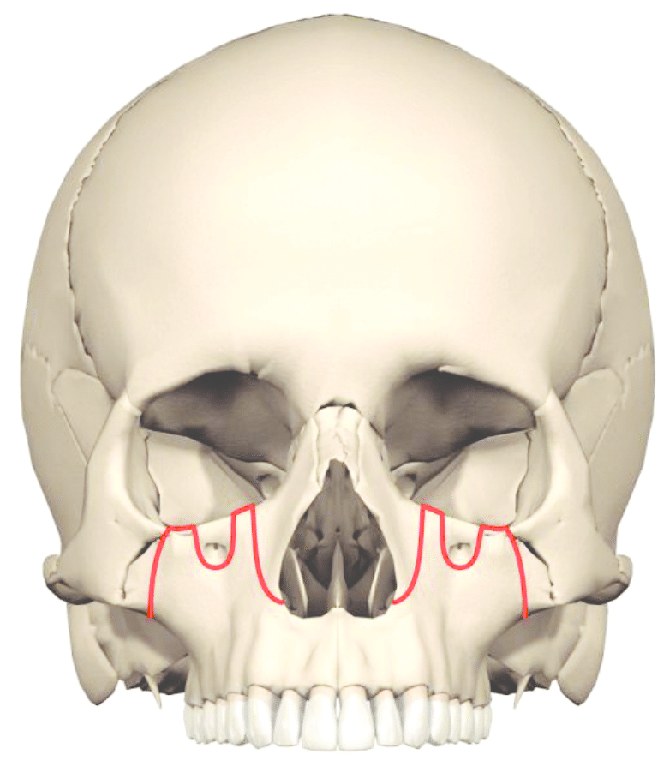 In some cases a high Le Fort I osteotomy is required for advancement of the entire