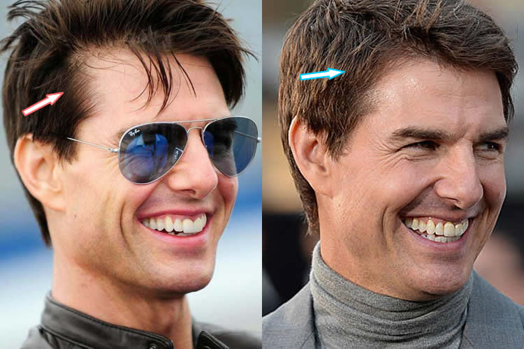 Tom cruise hair transplant