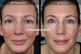 Retin-A for Wrinkles | 3-Year Results | Before & After ...