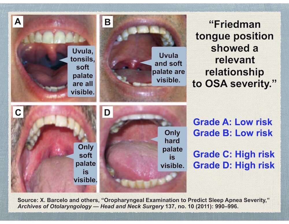 Friedman tounge position
