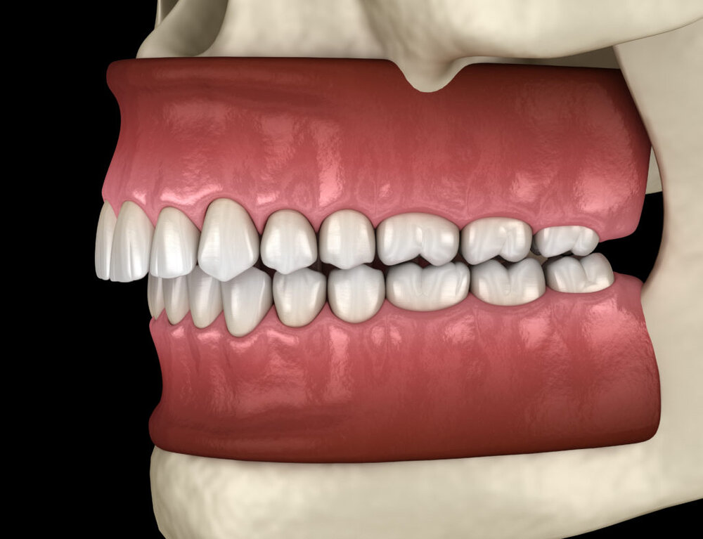 Overbite 1024x785