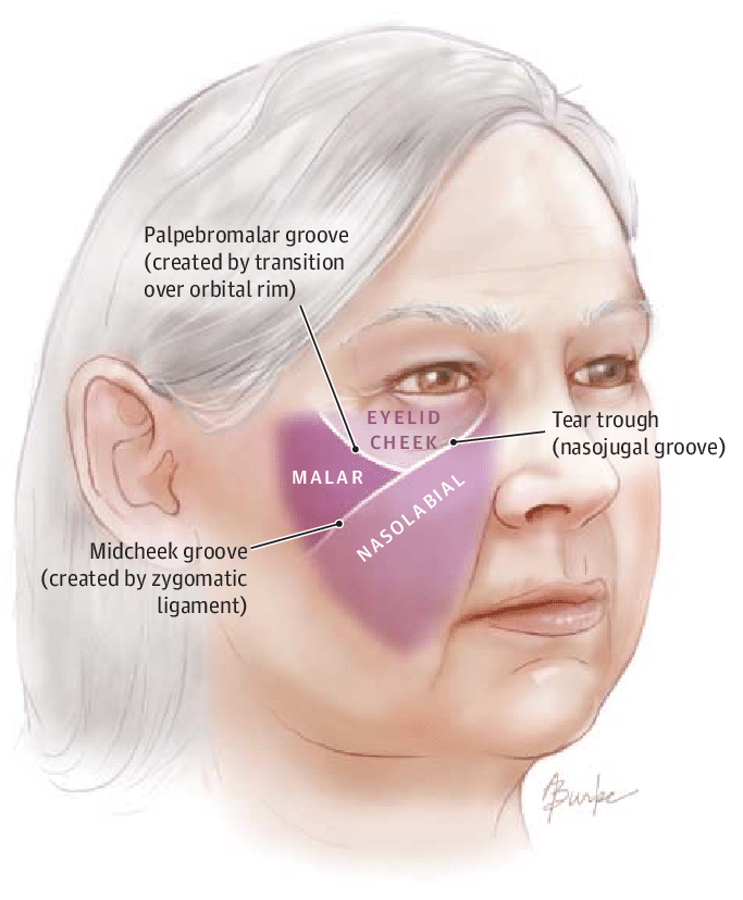 The Subunits of the Aging Midface Described by Mendelson and Jacobson 5