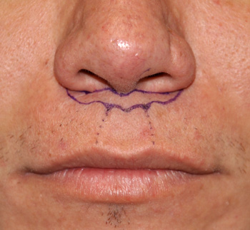 Subnasal Lip Lift Indianapolis Dr Barry Eppley