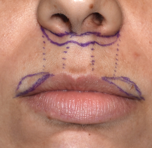 Subnasal Lip Lifts with Lateral Vermilion Advancements markings Dr Barry Eppley Indianapolis