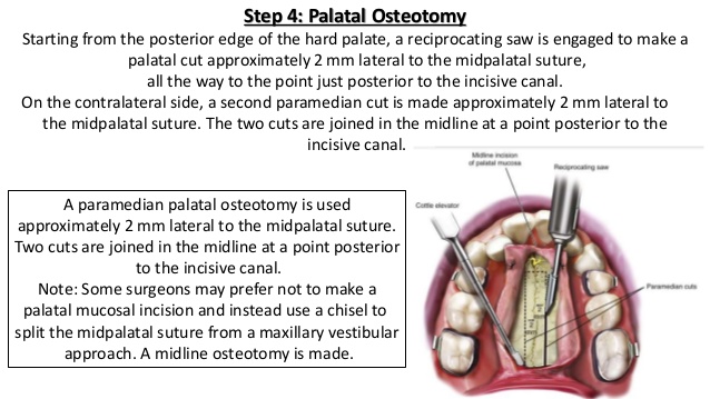 Surgically assisted rapid palatal expansion sarpe 21 638