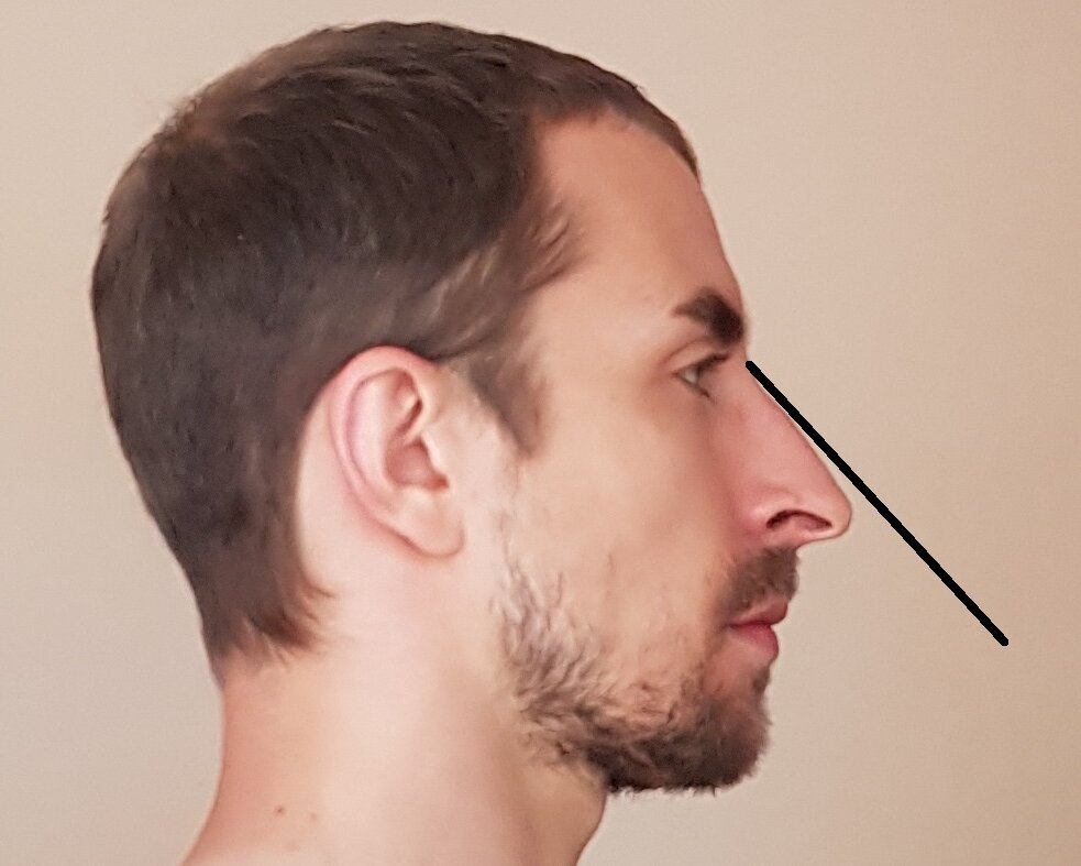 The only way to fix longer middle third surgically ( IT would work on ...