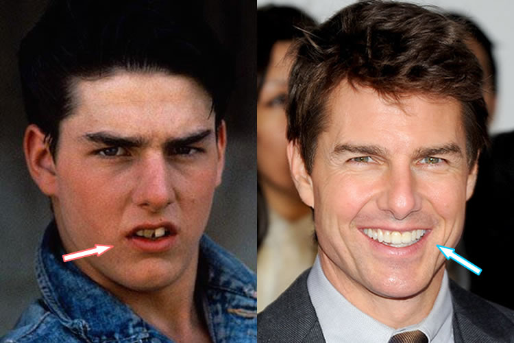 Tom cruise teeth