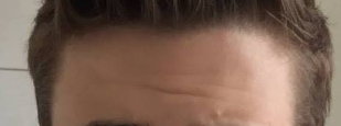 Nonreceded