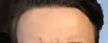 Receded