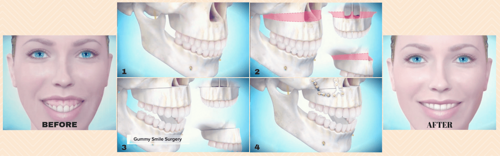 Facial Fillers Botox Specialist FMS DENTAL HOSPITAL Hyderabad India