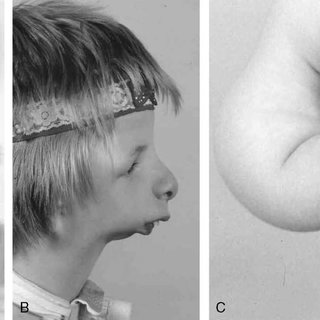 Clinical photos of patients 1 and 2 The mandibular micrognatia and malar hypoplasia are Q320