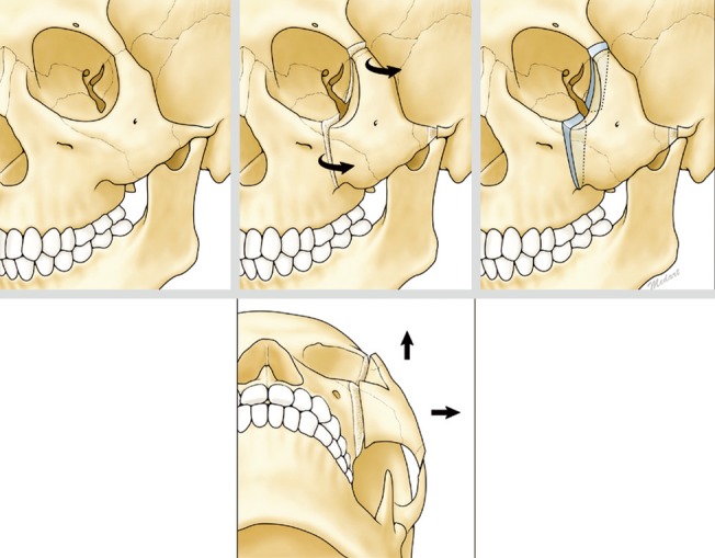 Tripod osteotomy Schema of orbital expansion by tripod osteotomy
