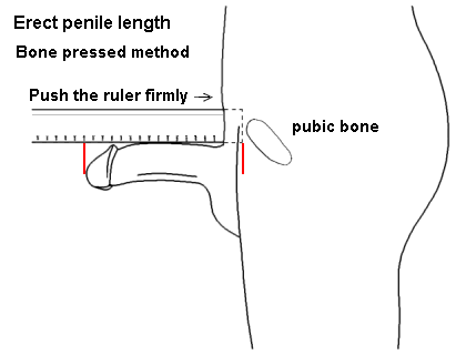 Erect penile length Bone pressed