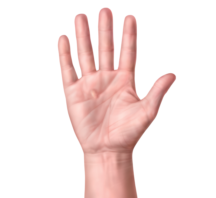 Hand nodules3x 1113x1020