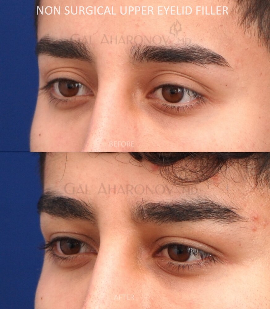Eyelid filler loose skin blepharoplasty nonsurgical hollowness