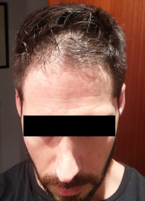 Antes 1