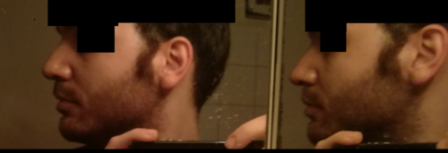 rhinoplasty after side.png