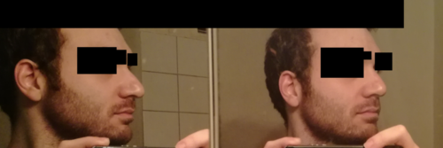 rhinoplasty before side.png