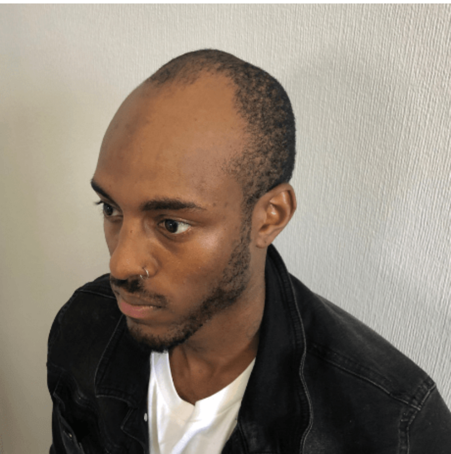 Deathstar tier hairline