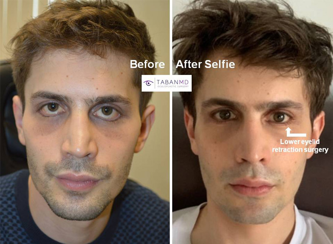 Neumann before after mn