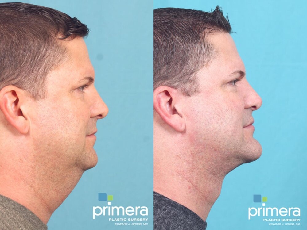 Submentoplasty chin tuck 593 right side detail